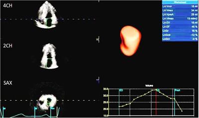 Evaluation of the relationship between left atrial strain and exercise tolerance in patients with hypertrophic cardiomyopathy by treadmill stress echocardiography
